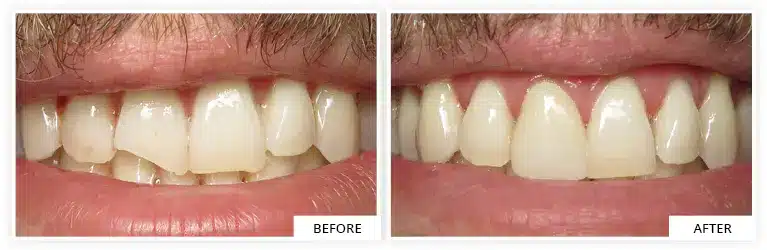 before and after teeth transformation