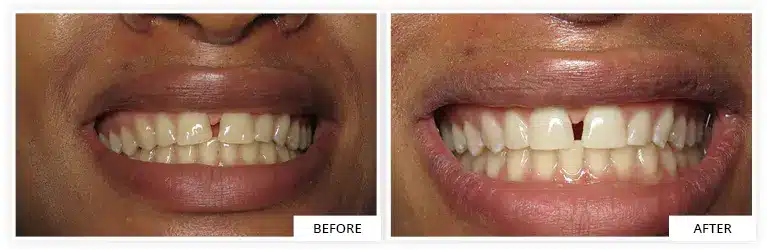 bright teeth transformation with etomi-bleaching