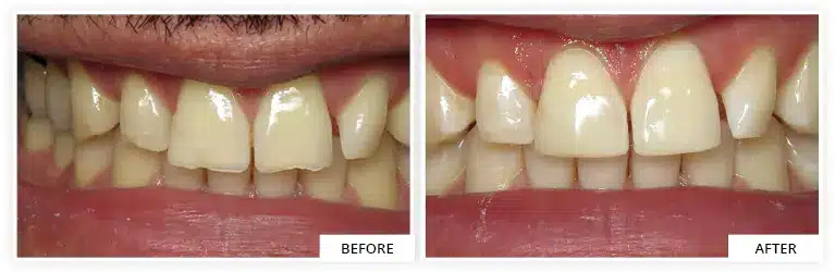 effective front composite bleaching in Silver Spring MD
