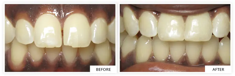 before and after invisalign bond transformation