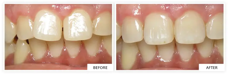 beautiful invisalign smile transformation