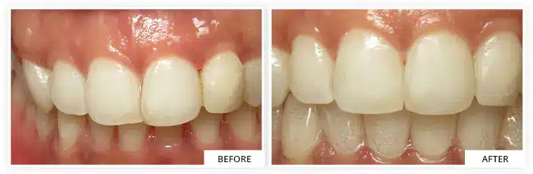 invisalign efficiency