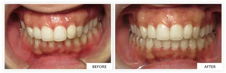 before and after smile transformation