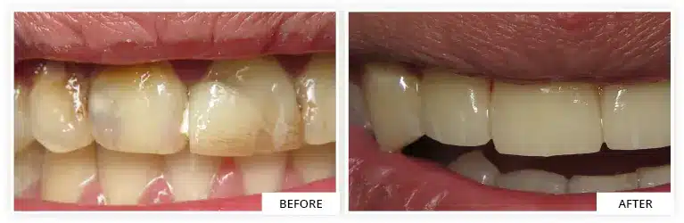 before and after teeth | beautiful result