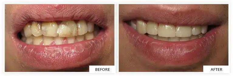 before and after teeth restoration Silver Spring MD