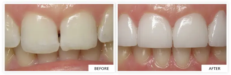 pearly white smile with porcelain veneers