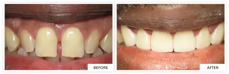 Smile transformation with Veneers