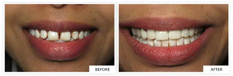 enhanced smile after veneers